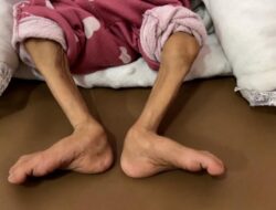 Kondisi Pilu Anak-anak Malnutrisi di RS Nasser Gaza